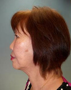 Facelift Before & After Image