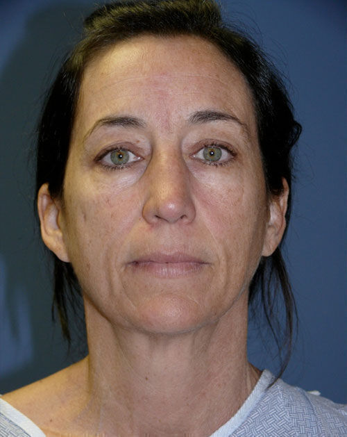 Facelift Before & After Image