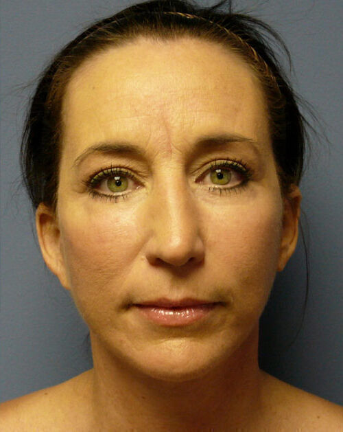 Facelift Before & After Image