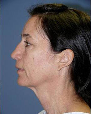 Facelift Before & After Image