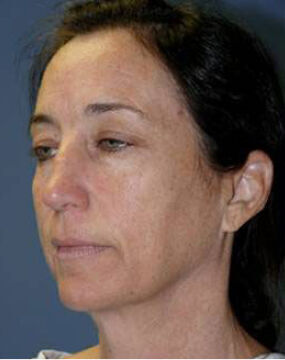 Facelift Before & After Image