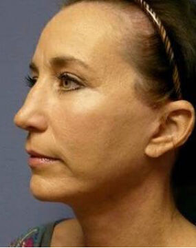 Facelift Before & After Image