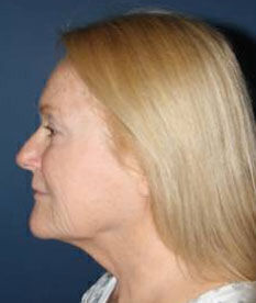 Facelift Before & After Image