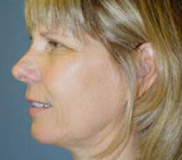 Facelift Before & After Image