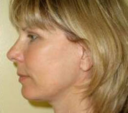 Facelift Before & After Image