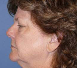 Facelift Before & After Image