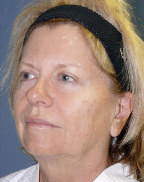 Facelift Before & After Image