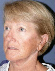 Facelift Before & After Image