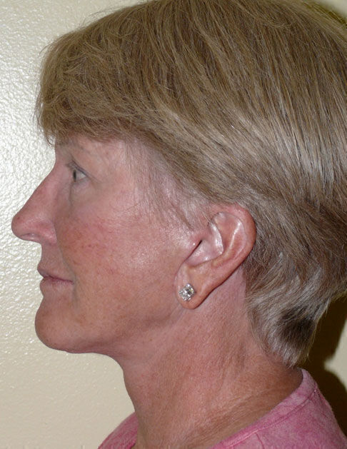 Facelift Before & After Image