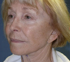 Facelift Before & After Image