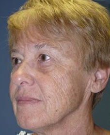 Facelift Before & After Image