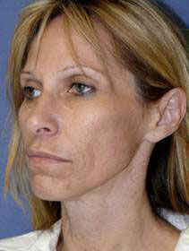 Facelift Before & After Image