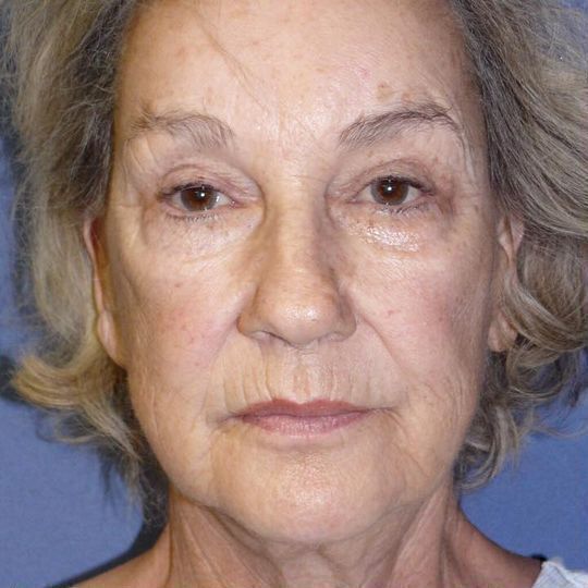 Facelift Before & After Image