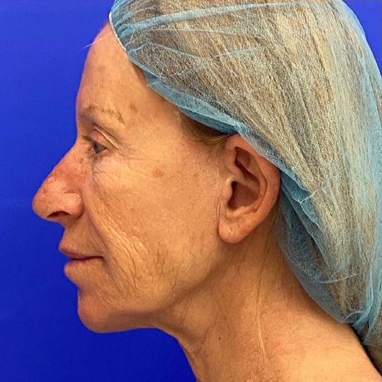 Facelift Before & After Image