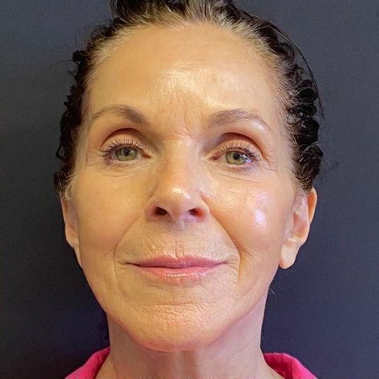 Facelift Before & After Image