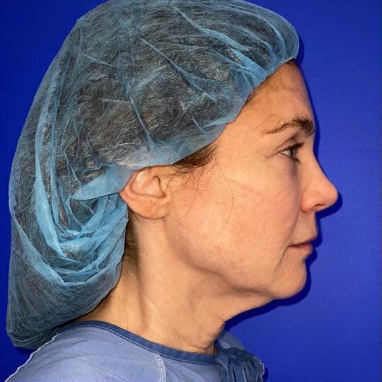 Facelift Before & After Image