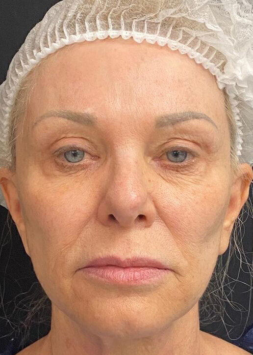 Facelift Before & After Image