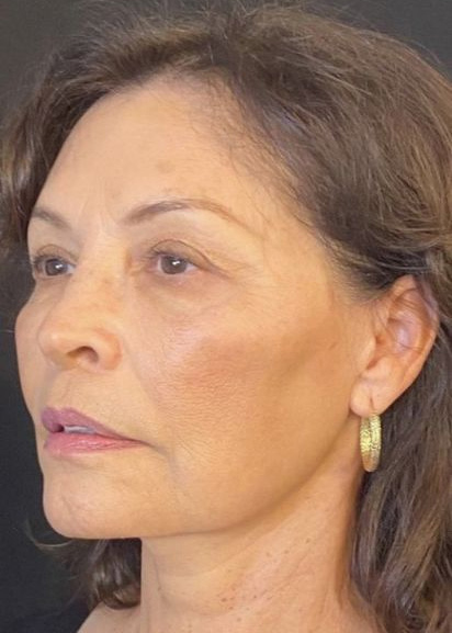 Facelift Before & After Image