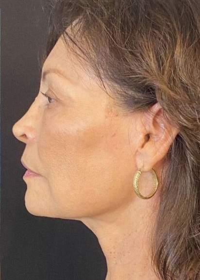 Facelift Before & After Image