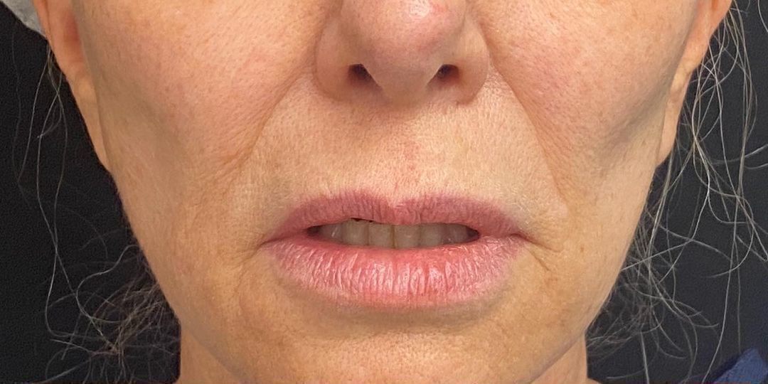 Lip Lift Before & After Image