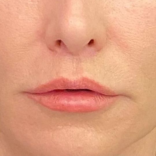 Lip Lift Before & After Image