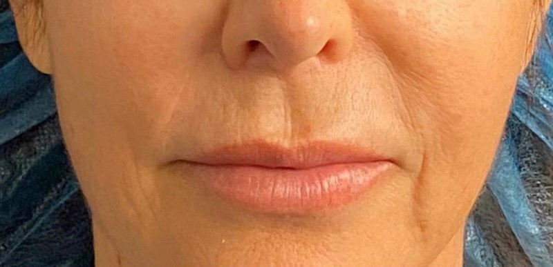 Lip Lift Before & After Image