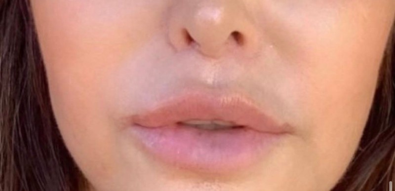 Lip Lift Before & After Image