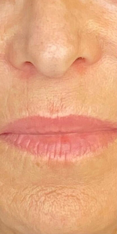 Lip Lift Before & After Image