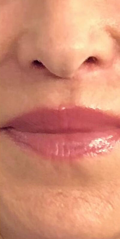 Lip Lift Before & After Image