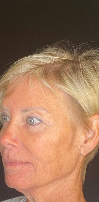 Lip Lift Before & After Image