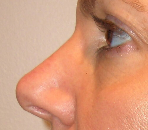 Liquid Rhinoplasty Before & After Image