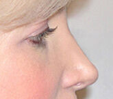 Liquid Rhinoplasty Before & After Image