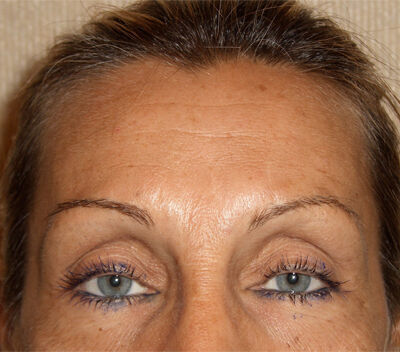 Non Invasive Before & After Image