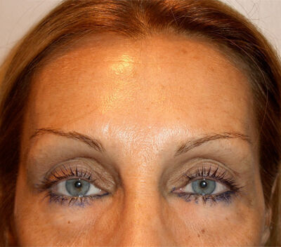 Non Invasive Before & After Image