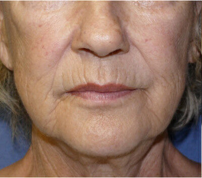 Non Invasive Before & After Image