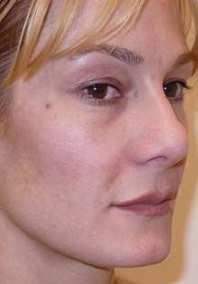 Non Invasive Before & After Image