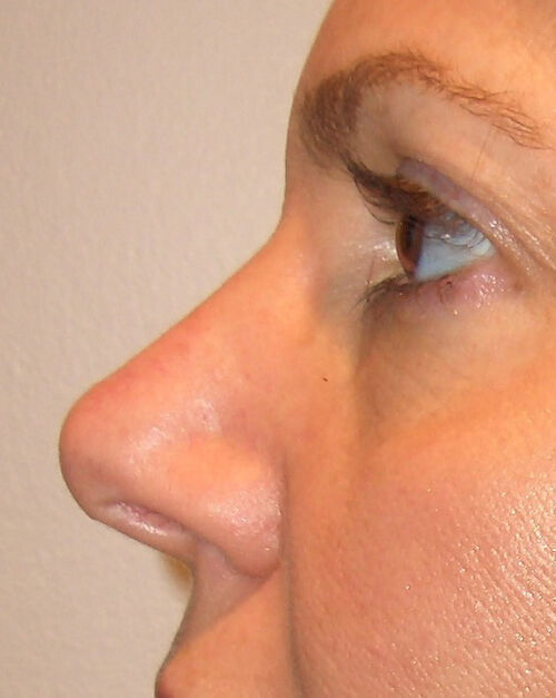 Non Invasive Before & After Image