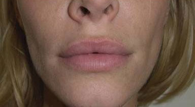 Non Invasive Before & After Image