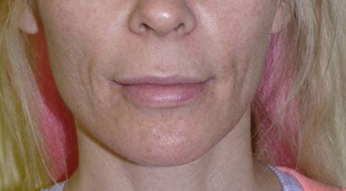 Non Invasive Before & After Image