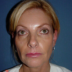 Non Invasive Before & After Image