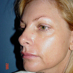 Non Invasive Before & After Image