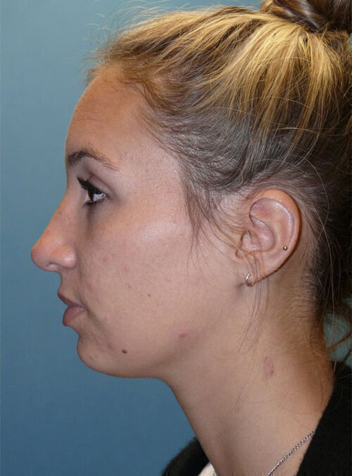 Rhinoplasty Before & After Image