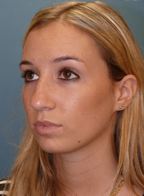 Rhinoplasty Before & After Image