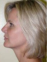 Rhinoplasty Before & After Image