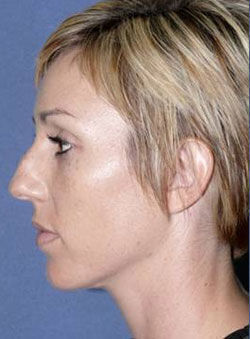 Rhinoplasty Before & After Image