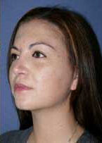 Rhinoplasty Before & After Image