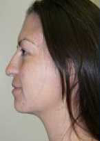 Rhinoplasty Before & After Image