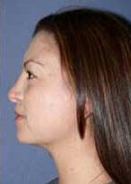 Rhinoplasty Before & After Image