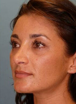 Rhinoplasty Before & After Image