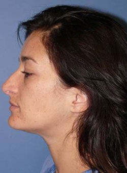 Rhinoplasty Before & After Image